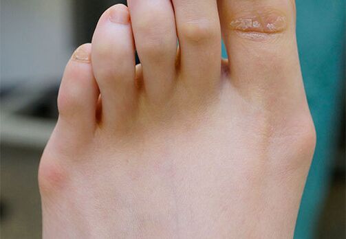 Valgus
