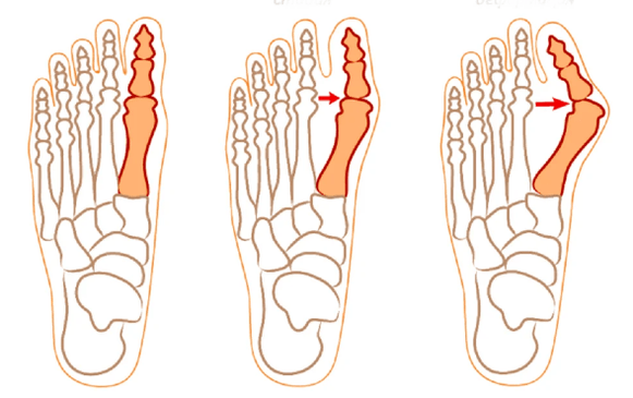 Hallux Valgus Deformation