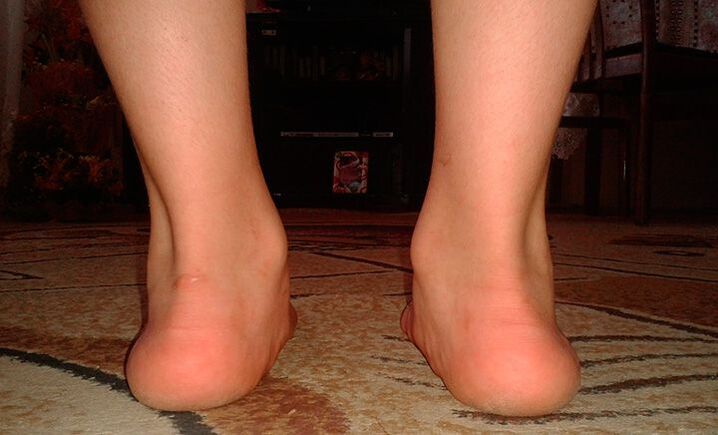 Flat valgus foot