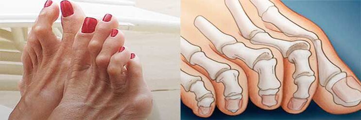 Hammer toe deformity