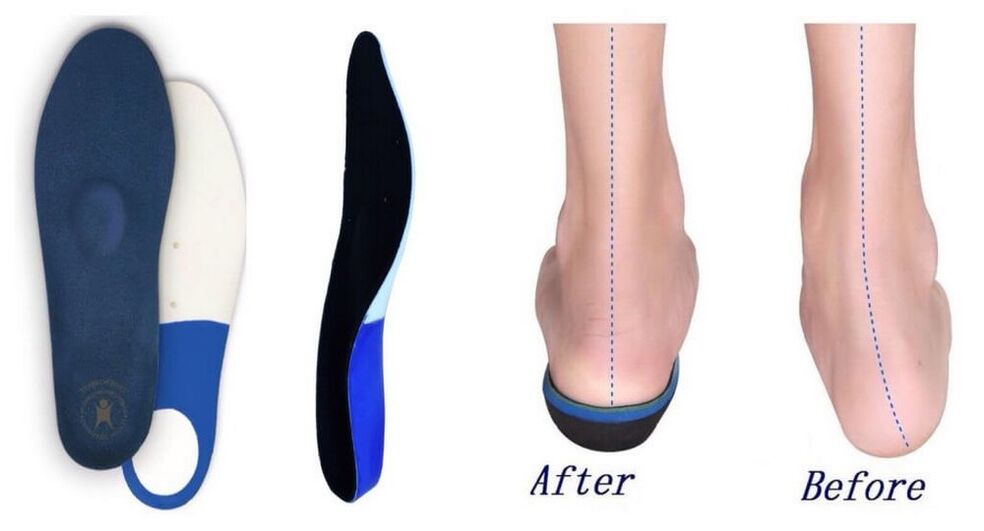 Orthopedic insole for plano-valgus foot deformity
