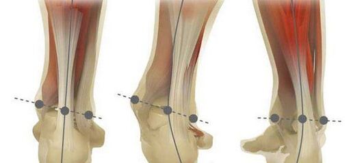 The norm and curvature of the leg axis in case of plano-valgus deformity