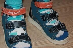 wearing hallux valgus sandals in children