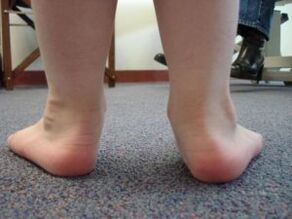 Flat valgus foot deformity in children