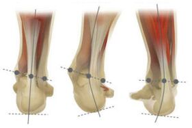 Normal foot, with calcaneus valgus and varus deviation