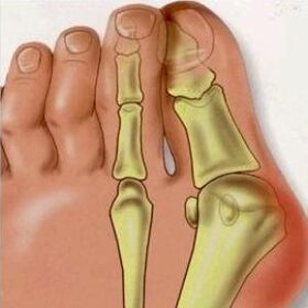 The causes of the valgus