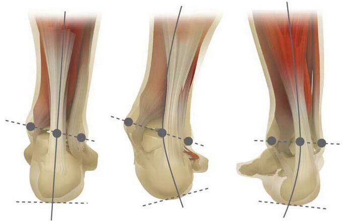 The types of valgus