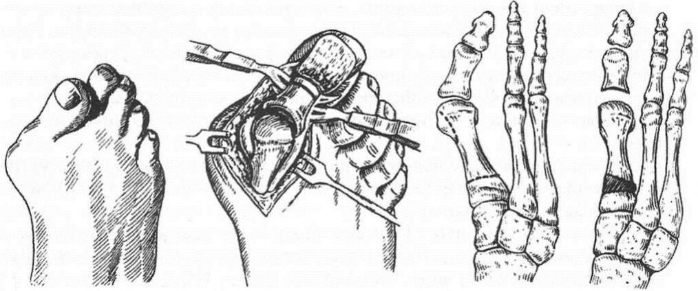Type of treatment