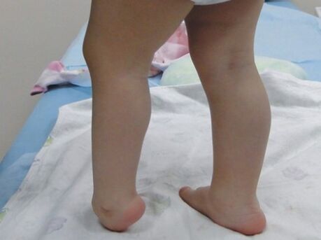 First symptoms of leg deformation