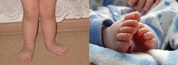The deformation of the footadarus