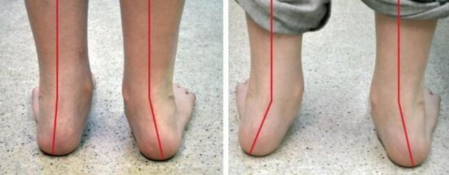 Valgus