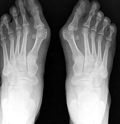 X -leg is the foot