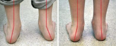 Valgus curvature